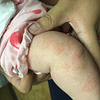 去医院抽了血化验医生说是过敏了，开了药擦和吃的 几天了感觉没什么效果，有宝妈遇到过这样的吗？ 脱皮