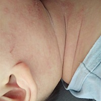 这几天温度高，宝宝几个晚上脖子上长了好多，不知道是湿疹还是痱子，要怎么办？这几天哭闹烦躁不安，
