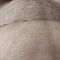第一胎剖腹，第二胎也要剖腹，第二胎真的痛的要死，子宫收缩太痛了，现在想想还是蛮难的，这个是手术半...