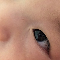宝宝现在四个月了，出生眼角下就有洞，这是怎么了？有知道的宝妈吗？