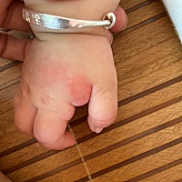 宝宝最近长了红红的红点中带有个白点点.满手都是、有哪位宝妈知道这是什么嘛