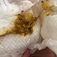 宝宝22天了，最近几天拉的屎都是这样的，并且很臭，怎么回事？谢谢