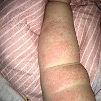 各位宝妈们，宝宝两条胳膊都起了痱子，擦了药也没见好，我还开的空调，好几天了痱子都 下不去