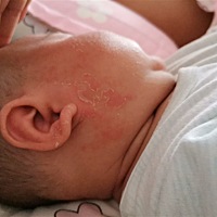 睡一觉起来就长了一点点没有管他，第二天早上就变成这样了，这是因为什么？才长这样的皮皮