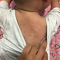 想问下各位宝妈，宝宝身上起这个是怎么回事？看了2个医生都说宝宝敏感皮肤过敏引起的，开的药膏，抹上就...