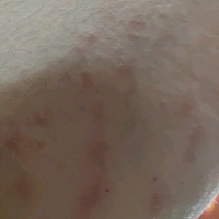 有没有产后妊娠纹特别痒的，越挠越痒，超级痒的那种，最后你们咋解决的呢？
