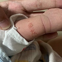 宝宝的手长了这个 有人知道这是什么吗