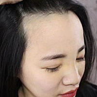 不论生没生小孩都挺在意外在的形象，但是脱发太严重了，所以选择了植发，整个M发际线，确实朋友都说变得...