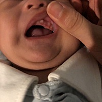 从出生就有，不过就两个小痘痘，我就没在意，今天突然扒他嘴巴看见好多颗牙，吓死我了，上网看说是马牙...
