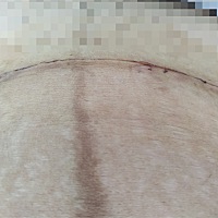 第七天！感觉伤口不痛！旁边的表皮肉痛的很！