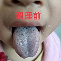 我家宝宝调理脾胃之前舌苔的变化太明显了，以前宝宝不爱吃饭挑食容易便秘睡不踏实口臭舌苔厚我以为是正...