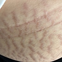 有没有宝妈像我一样严重的妊娠纹，你们有什么哺乳期去妊娠纹的好办法吗？