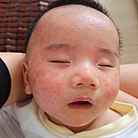 这么小怎么就得了幼儿急疹？满脸都是，身上还好，真可怜