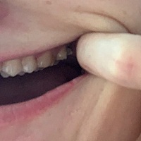 现在母乳喂养还在坐月子期间，痛得饭吃不下，晚上睡不着，喝口水都是痛的，有没有宝妈们拔牙后不种牙的...