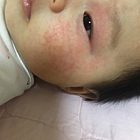 宝妈们 有没有没有激素的湿疹膏推荐啊 我家宝宝总是反反复复张湿疹 好了两天又开始张 看着她好难受呢