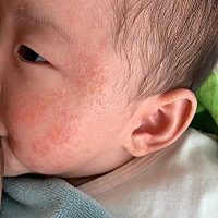宝宝湿疹有办法吗？越来越严重了，求救......