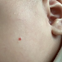 两个月宝宝脸上长了红痣