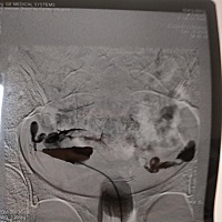 我的子宫是不是偏右的太狠了，左侧输卵管又细又长，医生说精子不容易游到，右侧输卵管又高举，也不容易...