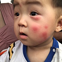 宝宝早上发现脸上有好几个红疙瘩，然后下午红的范围变大了，还变硬了，是被蚊子咬的吗？应该怎么办呀，...