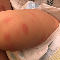 宝宝最近反复长这种红斑是怎么回事啊