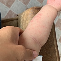 这是湿疹吗