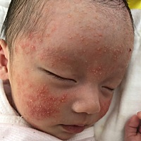 大家帮我看看 这是什么痘痘 涂了百多邦 感觉都长出来了