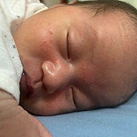 求问广大的宝妈们，宝宝脸上的这个是湿疹么？或者是其他什么东西？我看好多人说用金银花泡水敷脸上有用...
