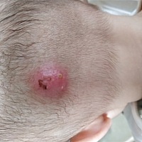 之前是一个小疱，被我用针刺了一下感染了就肿成下面的那种脓疱，带到医院去看，医生就开了百多邦的药膏...