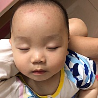 已经2天，忽然间就这么多包包，不知道怎么回事？感觉又不像蚊子咬的，之前蚊子咬的，第二天就是一个小红...