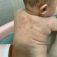 有没有宝妈知道这些红块块是什么东西？之前都没有，就今天洗澡发现的，不是过敏的症状，在线等回复，急...
