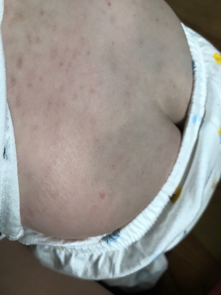 九个月的婴儿5.22发高烧，5.25退烧，期间高烧退烧反复。5.26出疹子，到5.30还没消。5.31号又低烧37.7，同时疹子变多更红。6.1疹子越来越多。带去看医生，检查后说是幼儿急疹，肚子上都是大片皮疹。6.4号，期间疹子越来越多，有擦了医生的药水也吃了药。6.5皮疹消退，脸上头皮上基本上干净了。但是身上却留了印子，到今天6.12还没消褪，偶尔还看到手臂上又长出新的红点点。有懂的人帮忙下吗？这些印子要怎么处理才能消褪？谢谢