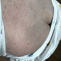 九个月的婴儿5.22发高烧，5.25退烧，期间高烧退烧反复。5.26出疹子，到5.30还没消。5.31号又低烧37.7，...