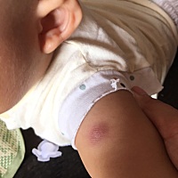 已经1个半月，这样怎么办，打了疫苗后