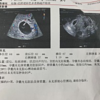 医生说等一个星期复查，有没有姐妹经历过？￼￼￼￼￼￼￼
