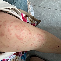 第一篇来说说面对哺乳期的寻麻疹。真的是特别理解哺乳期患上寻麻疹的妈妈们！折腾了我二十多天终于结束...