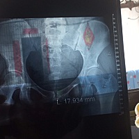 这是在产后42天医院拍的片子，医生建议修复，价位比较高，我见网上有卖仪器的，有没有自己修复的宝妈，...