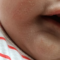 宝宝脸上湿疹怎么办，用什么药膏比较好？