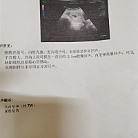 胎心胎芽胎囊都有了是吗？