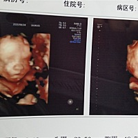 我们的四维照片出来啦～～ 本来小脸是全露出来的，但宝宝不怎么动，看不到左手，娃爹说了一句鼻子像我以...