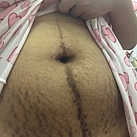 顺产侧切加撕裂第24天伤口依旧还没痊愈，平躺睡觉已经24天了 还是翻身侧睡不了 上厕所都是半蹲  还有六...