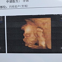 图一是24周四维，图二、三是刚出生，图四是我们42天。 刚出生7.6斤满月10.3斤，42天11斤。纯母乳喂养，...