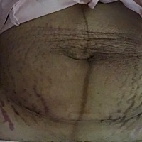 不敢想象这是我的肚子，这个宝宝付出的代价…
