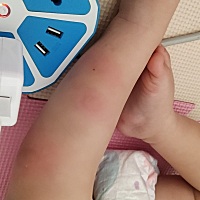 就一会没注意就不知道怎么又被叮成这样，好不容易这两天有点好转，又被叮成这样，这真是要命，还没一会...