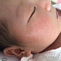 如题，宝宝28天，长在脸的两侧