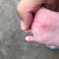 宝宝这些红点是什么情况，手掌心，脚底