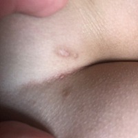 以前去医院烫过 现在中间又长了 看着好心疼  求助