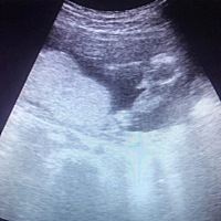 嘻嘻。17周。在深圳龙岗中心城附近的门诊看的。
