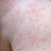 夏天宝宝爱长痱子，治疗宝宝痱子方法有很多。在这推荐最有效的一种方法-用绿苶水给宝宝洗澡。 这里的绿...