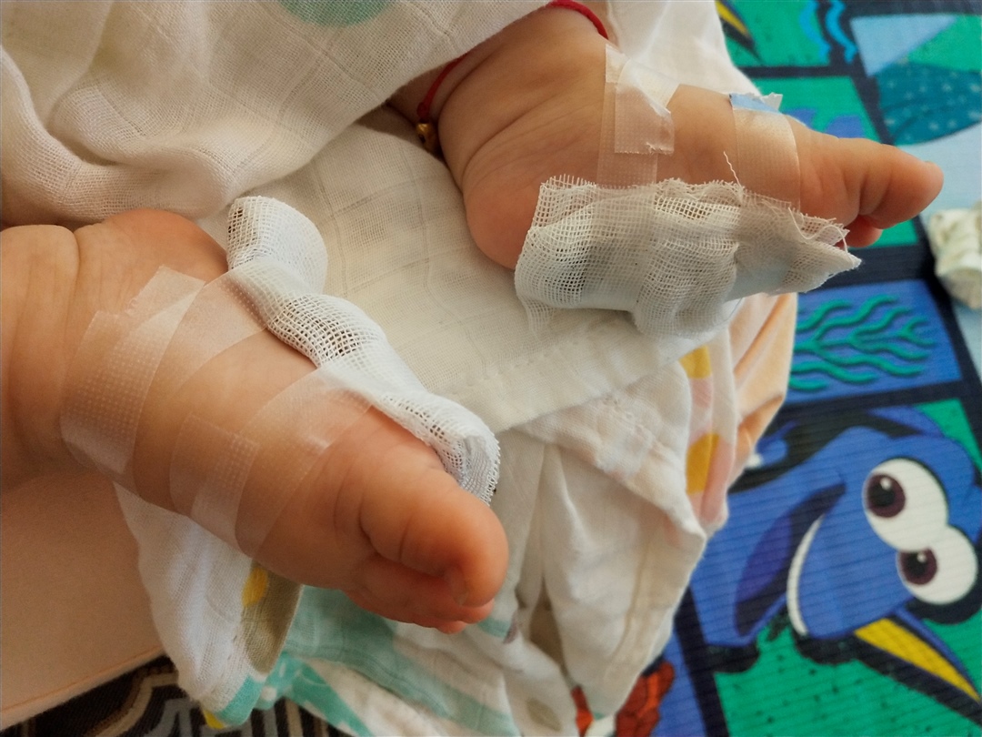 用姜敷脚底，只要好的快，土办法也可以试一试