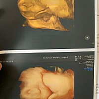 39 5凌晨见红，第二天早上七点半破水，九点半左右开始宫缩，一点半左右开三指打无痛，下午3.58分顺产7.1...